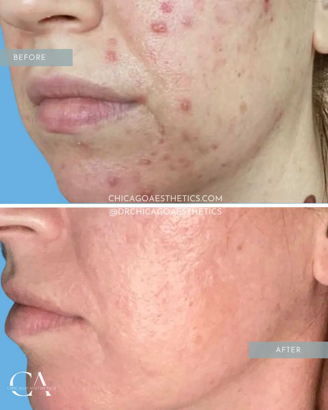 microneedling before and after chicago aesthetics