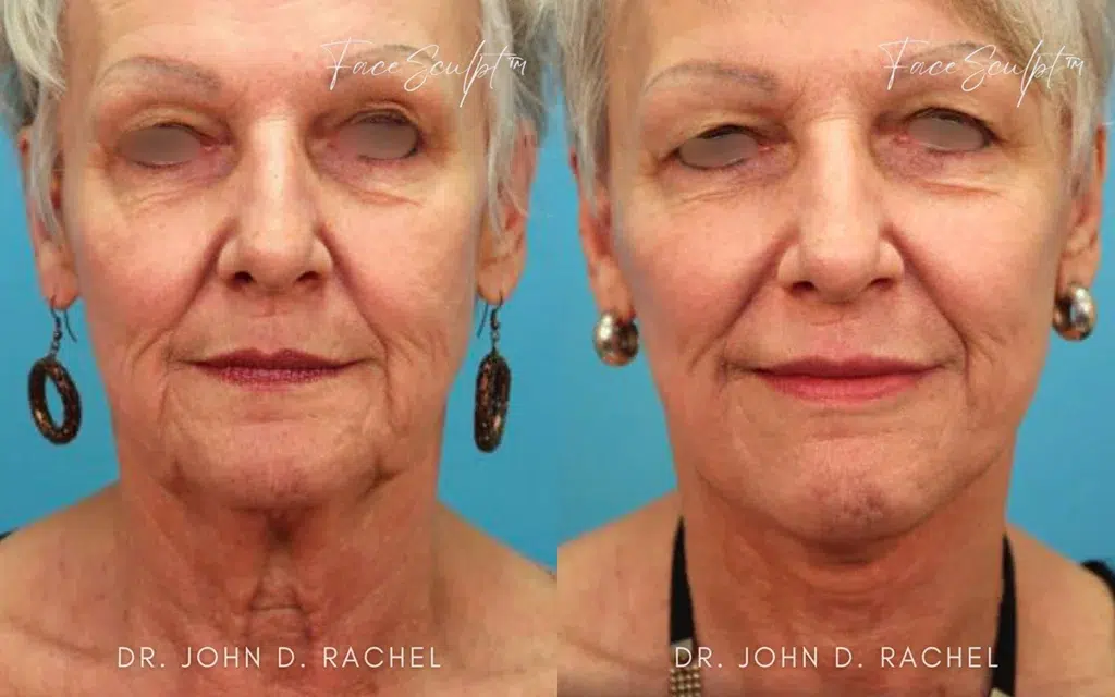 facelift before and after photo by chicago aesthetics surgery & med spa in chicago, il