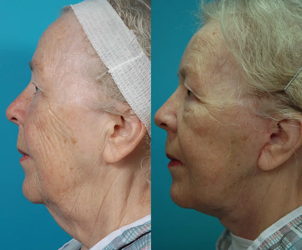 facelift before and after photo by chicago aesthetics surgery & med spa in chicago, il