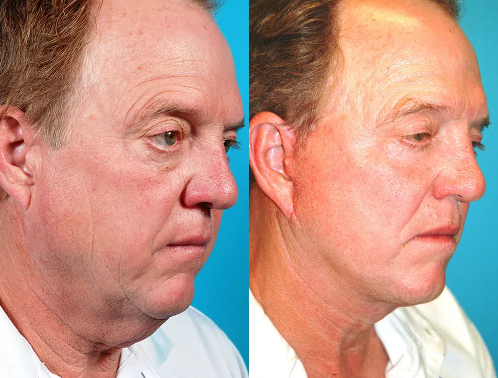 facelift before and after photo by chicago aesthetics surgery & med spa in chicago, il