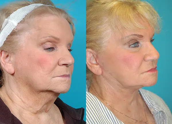 facelift before and after photo by chicago aesthetics surgery & med spa in chicago, il
