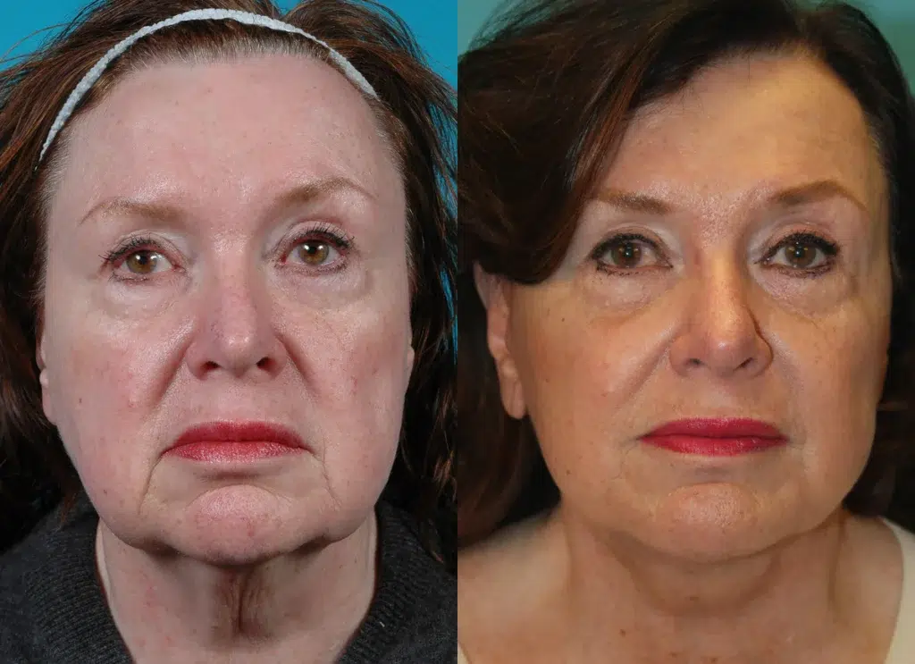 facelift before and after photo by chicago aesthetics surgery & med spa in chicago, il