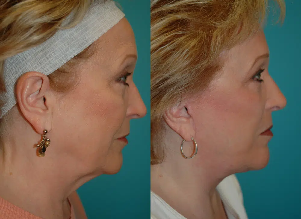 facelift before and after photo by chicago aesthetics surgery & med spa in chicago, il