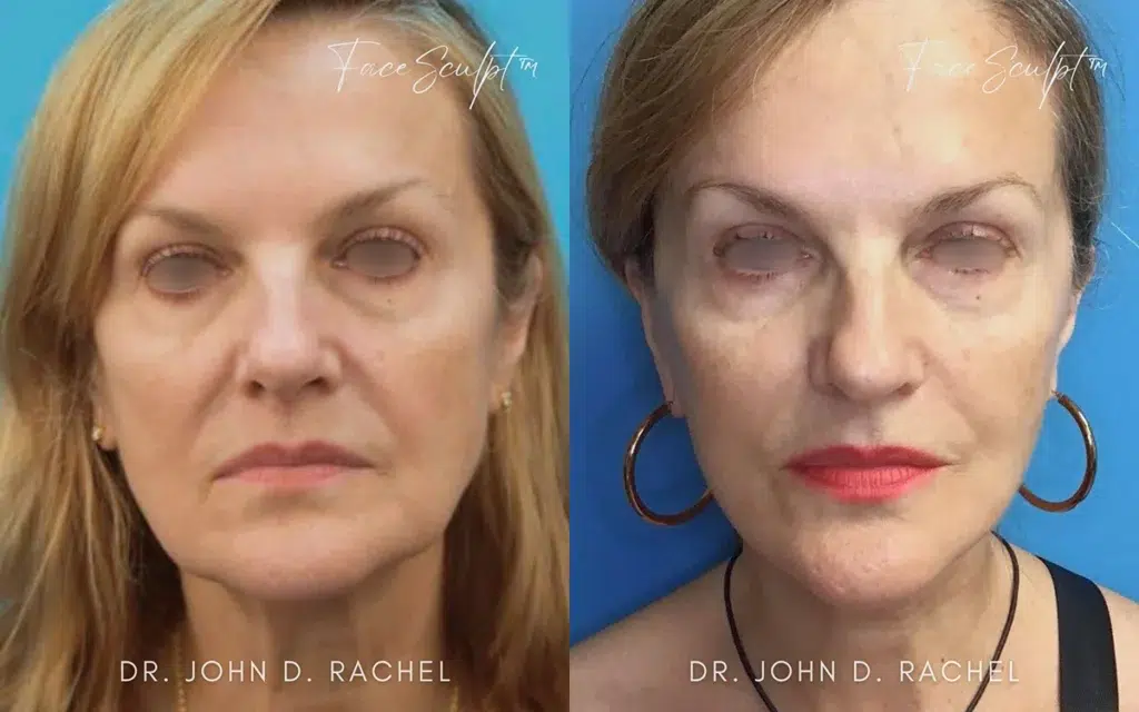 facelift before and after photo by chicago aesthetics surgery & med spa in chicago, il
