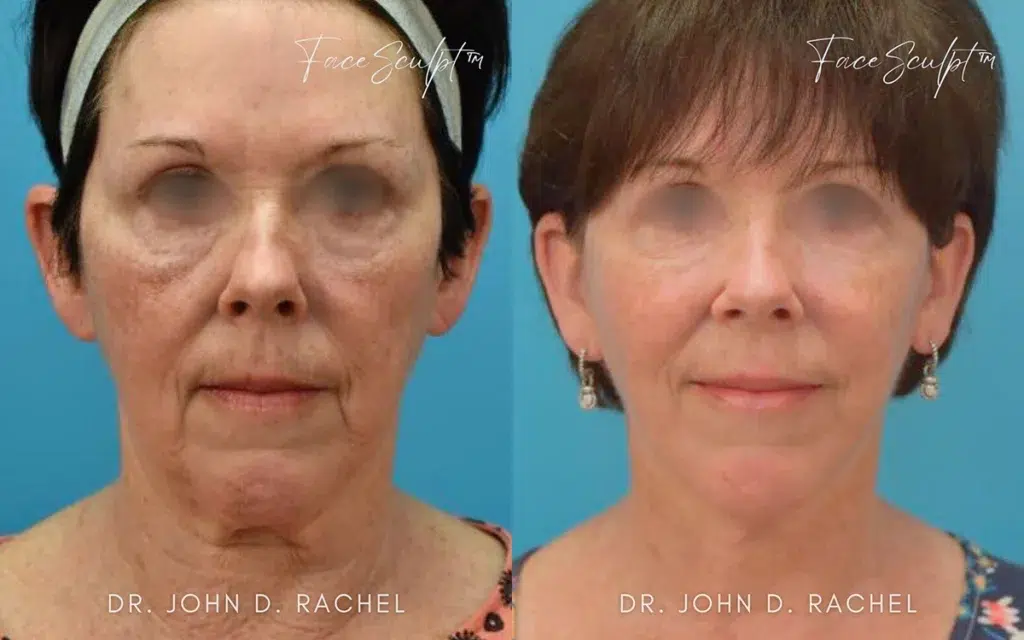 facelift before and after photo by chicago aesthetics surgery & med spa in chicago, il