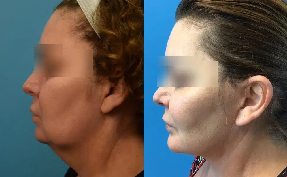 facelift before and after photo by chicago aesthetics surgery & med spa in chicago, il