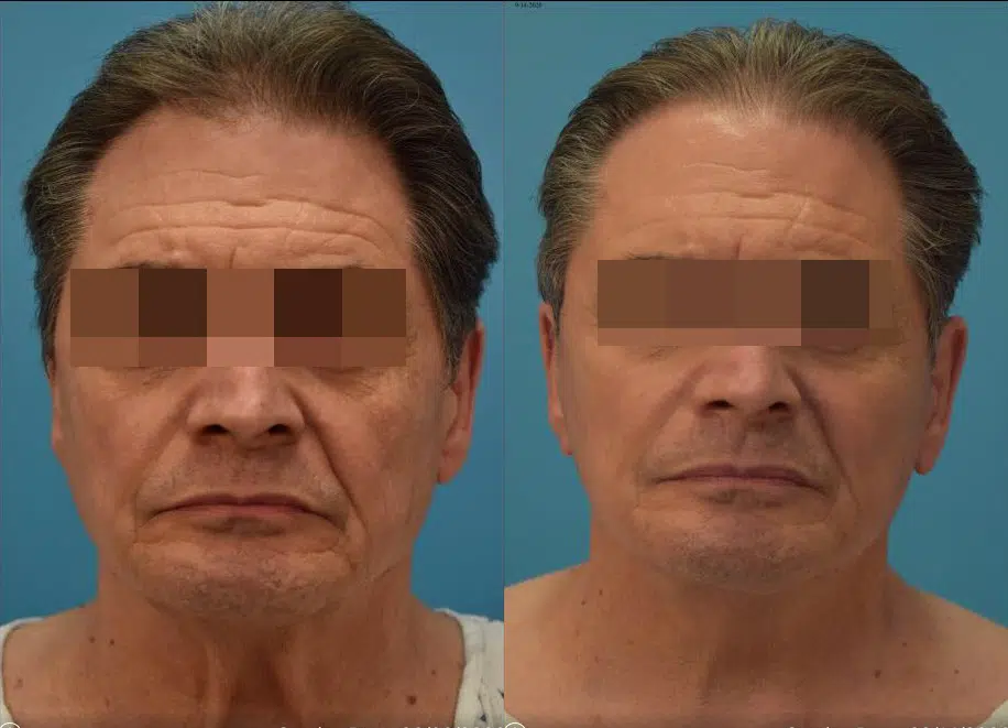 facelift before and after photo by chicago aesthetics surgery & med spa in chicago, il