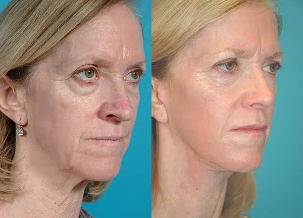 facelift before and after photo by chicago aesthetics surgery & med spa in chicago, il