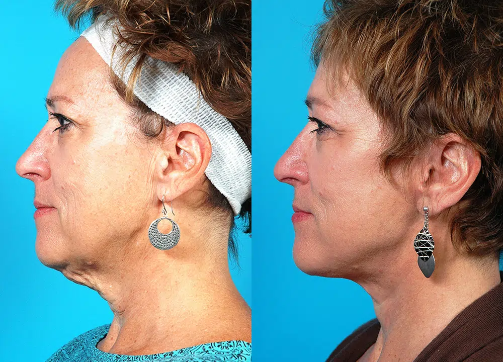 facelift before and after photo by chicago aesthetics surgery & med spa in chicago, il