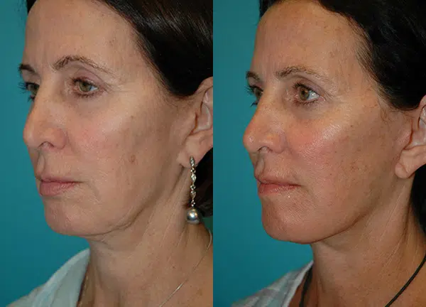 facelift before and after photo by chicago aesthetics surgery & med spa in chicago, il