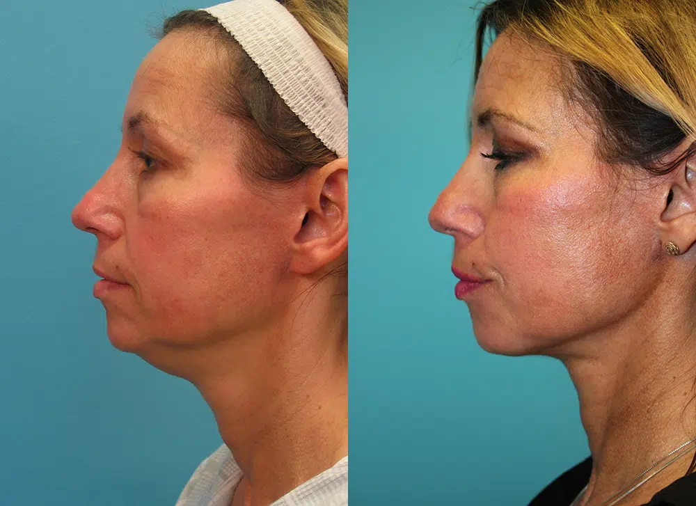 facelift before and after photo by chicago aesthetics surgery & med spa in chicago, il