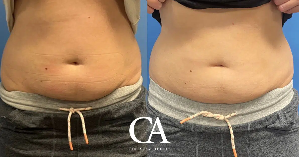 #644 Sculpsure Before After Photo - Chicago Aesthetics