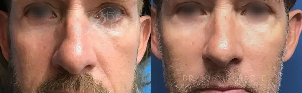 facial fat transfer before and after photo by chicago aesthetics surgery & med spa in chicago, il