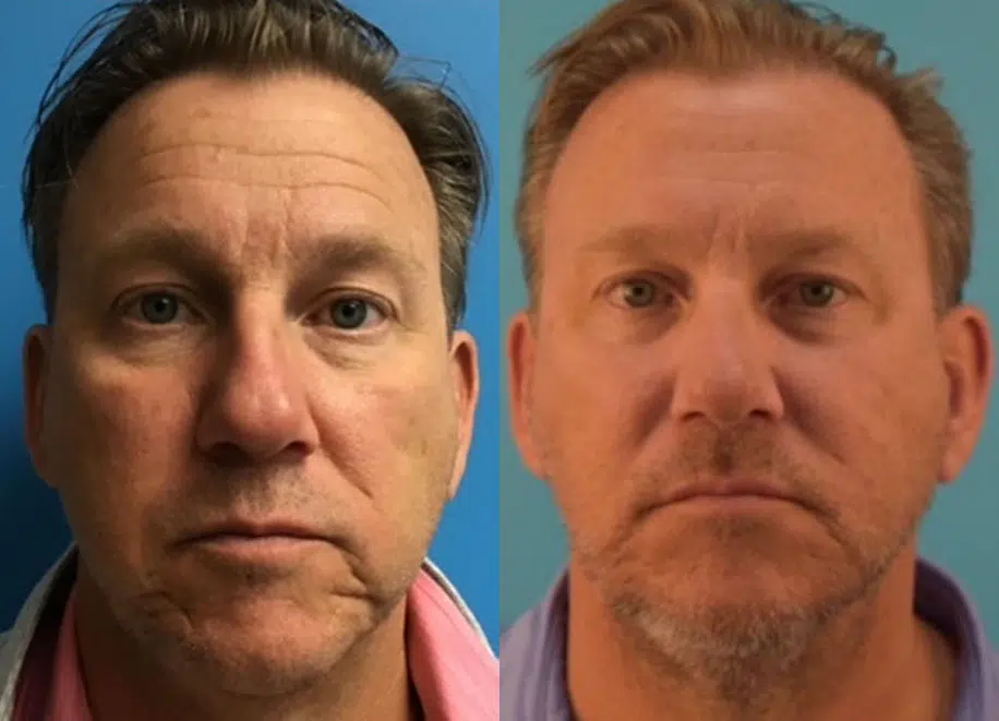 facial fat transfer before and after photo by chicago aesthetics surgery & med spa in chicago, il