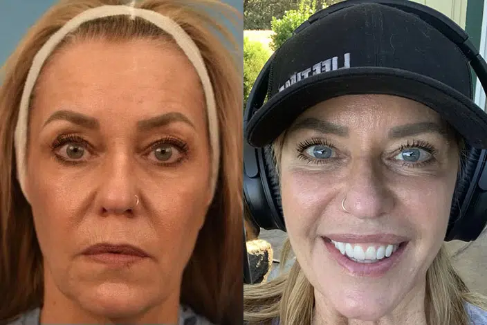 facial fat transfer before and after photo by chicago aesthetics surgery & med spa in chicago, il
