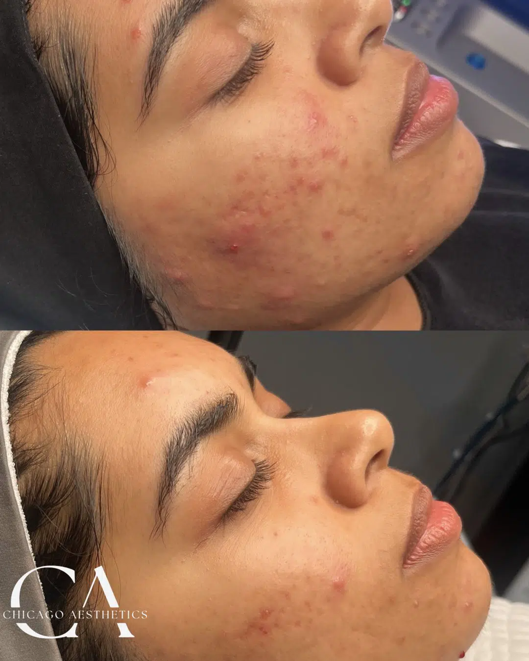 Acne Treament Chicago Aesthetics | Chicago Aesthetics Med Spa