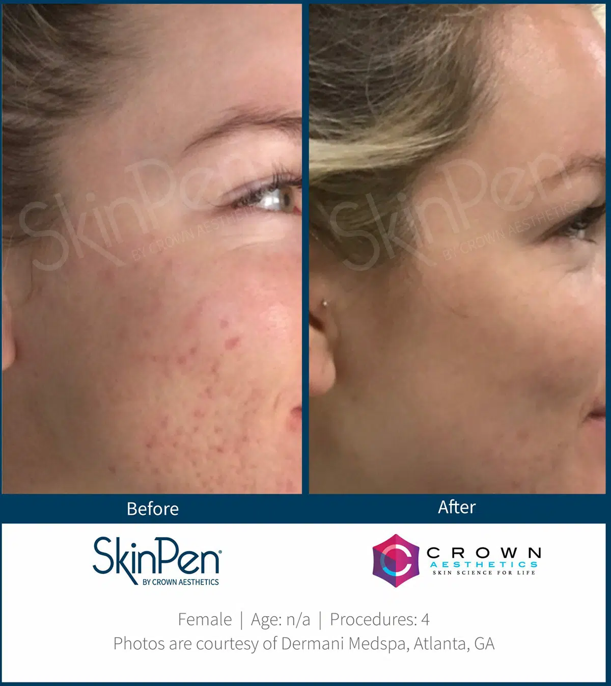 before after microneedling skinpen chicago