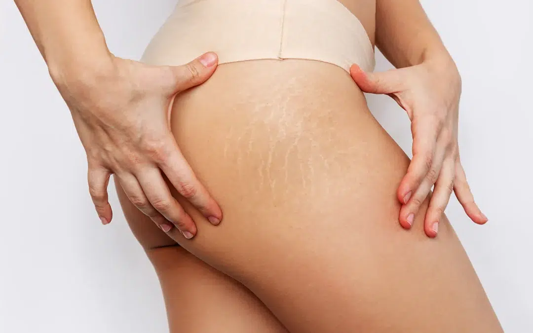 close up of a female thigh with white stretch marks