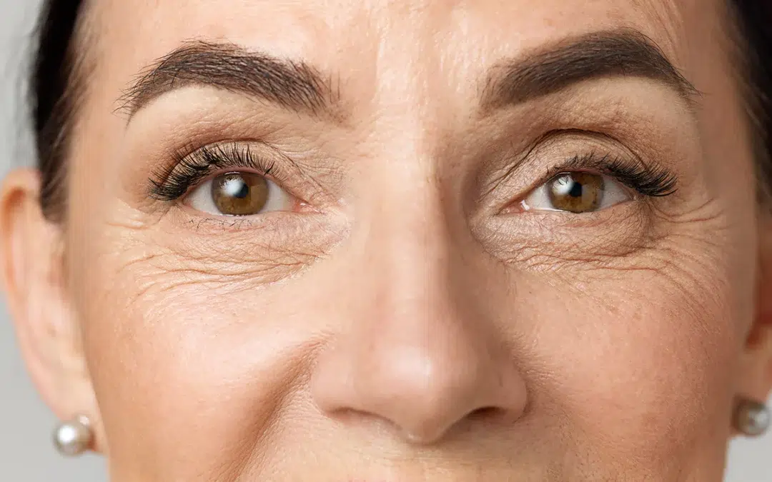 Blepharoplasty: Cosmetic Eyelid Surgery Chicago