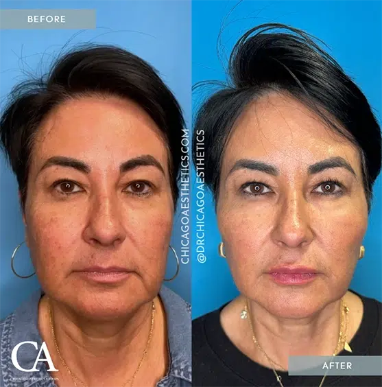 dermal filler treatments