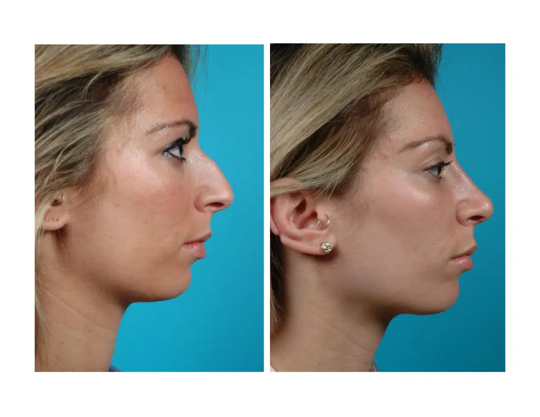 Side profile before and after rhinoplasty showing refined nasal shape