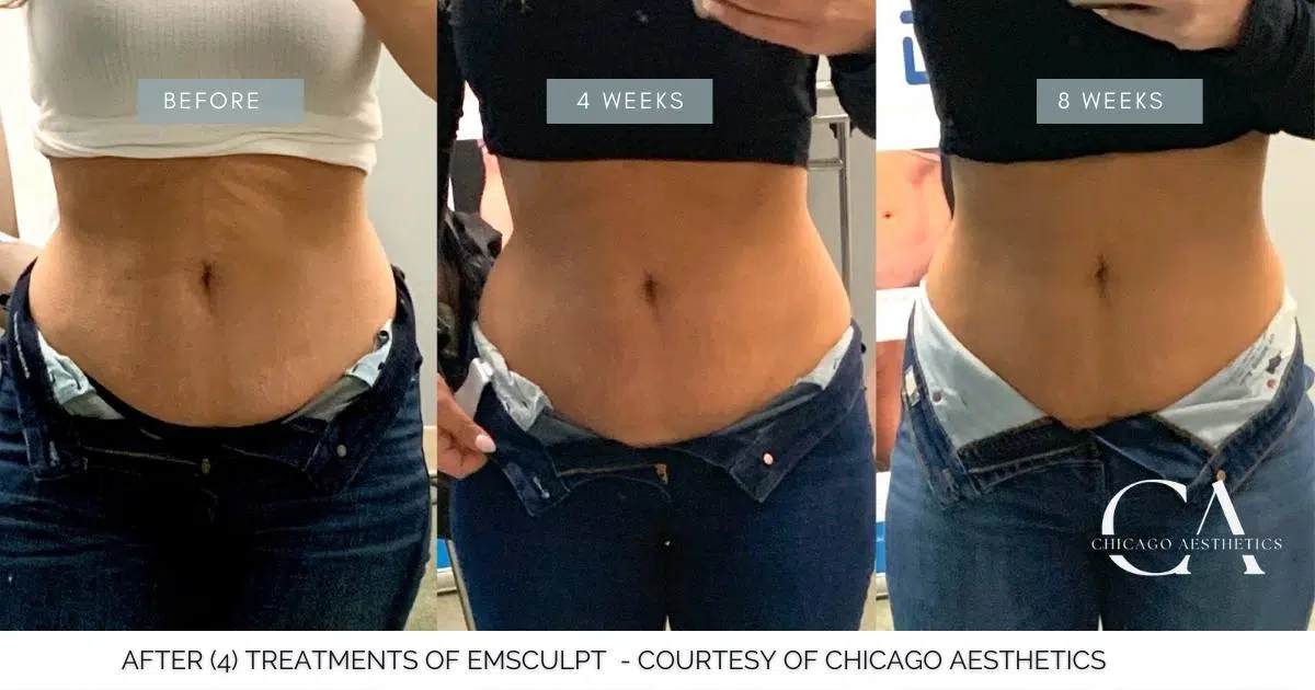 Emsculpt Abs Before After Photo Chicago Aesthetics | Chicago Aesthetics Med Spa