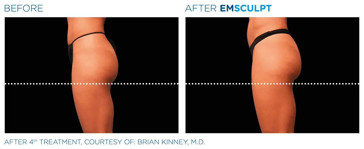 Non Surgical Butt Lift Emsculpt