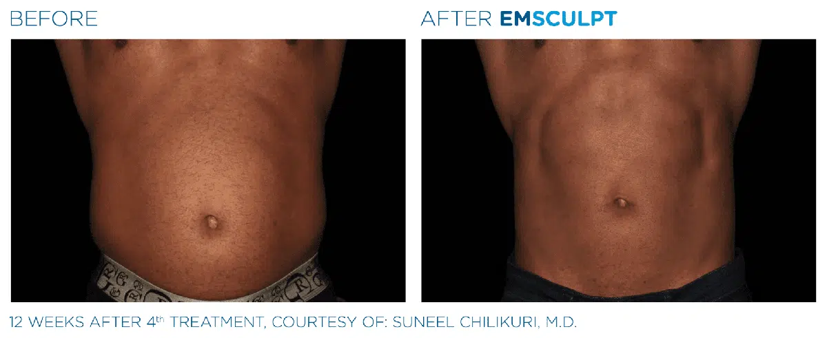 Emsculpt Abdomen Before After