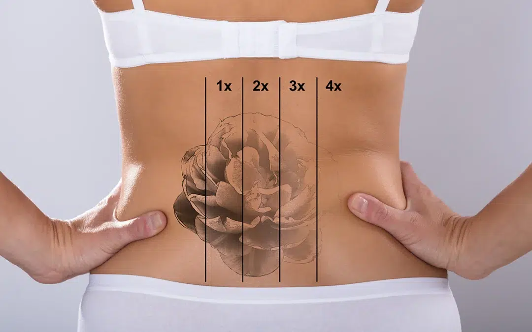 Tattoo Scar Removal Treatments