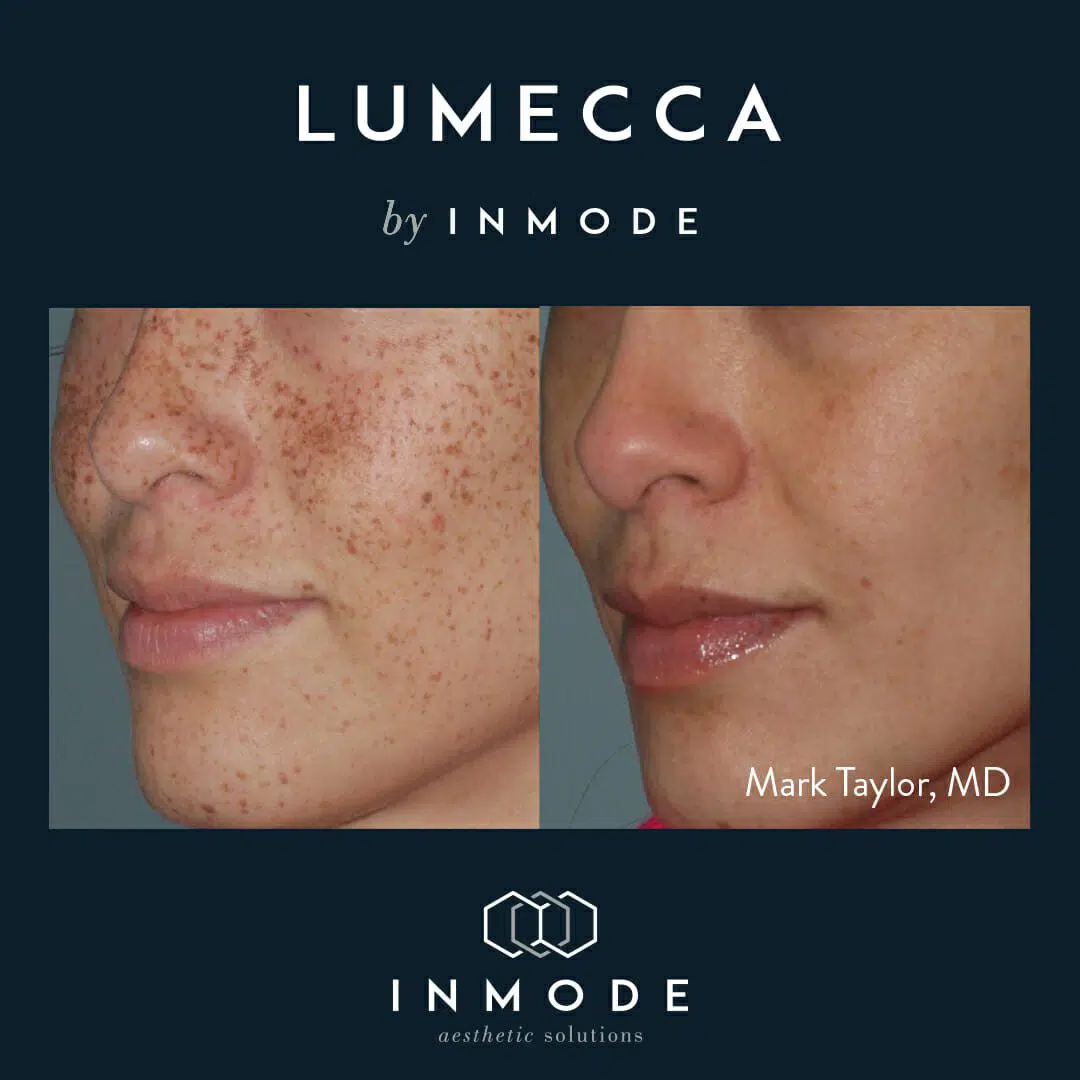 Ipl Lumecca Before And After Chicago