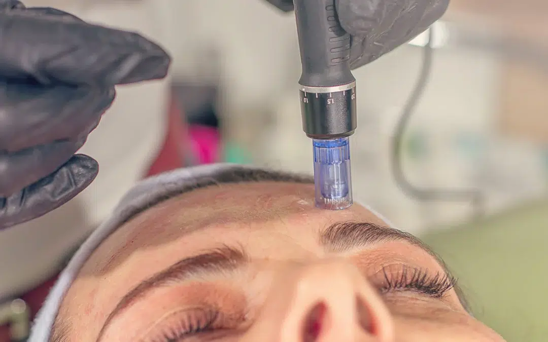 microneedling