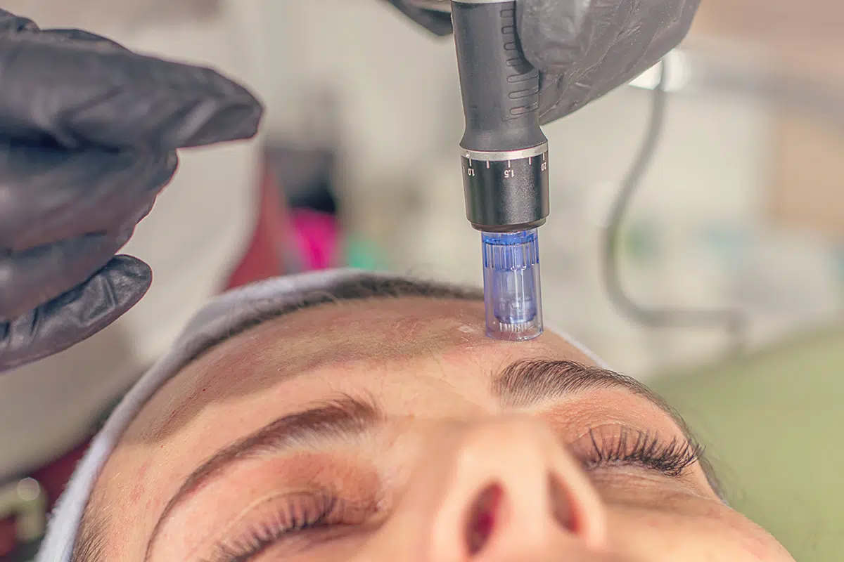 Skin-Pen-Microneedling-Best-Summer-Skincare-Treatments