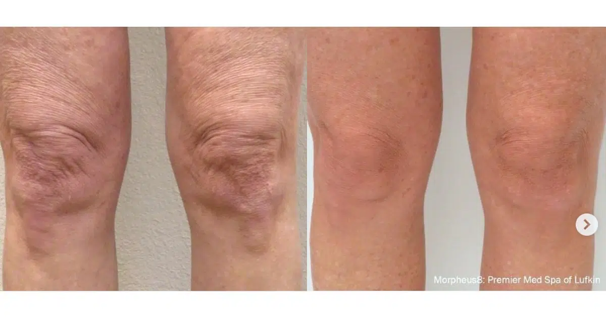 Morpheus8 Knees Chicago Aesthetics | Chicago Aesthetics Med Spa