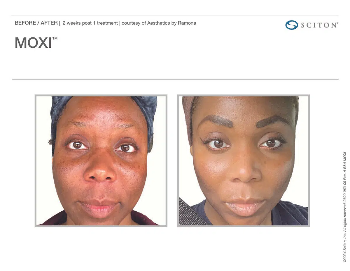 Moxi Before And After Chicago Aesthetics 1 | Chicago Aesthetics Med Spa