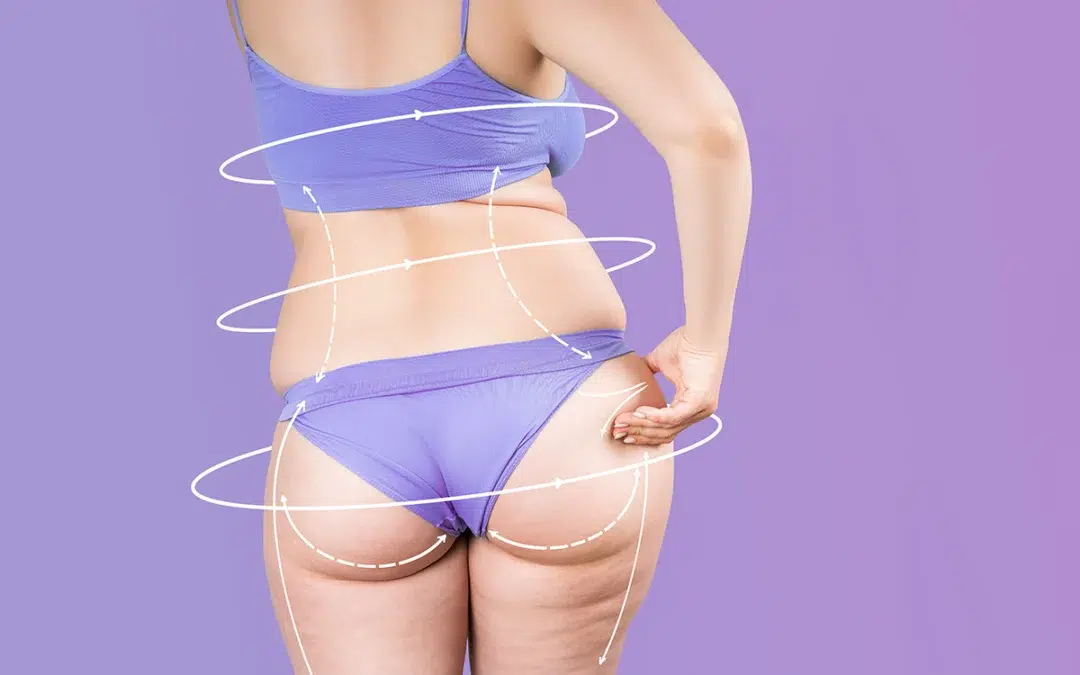 Liposuction: Chicago Fat-Reduction Procedure