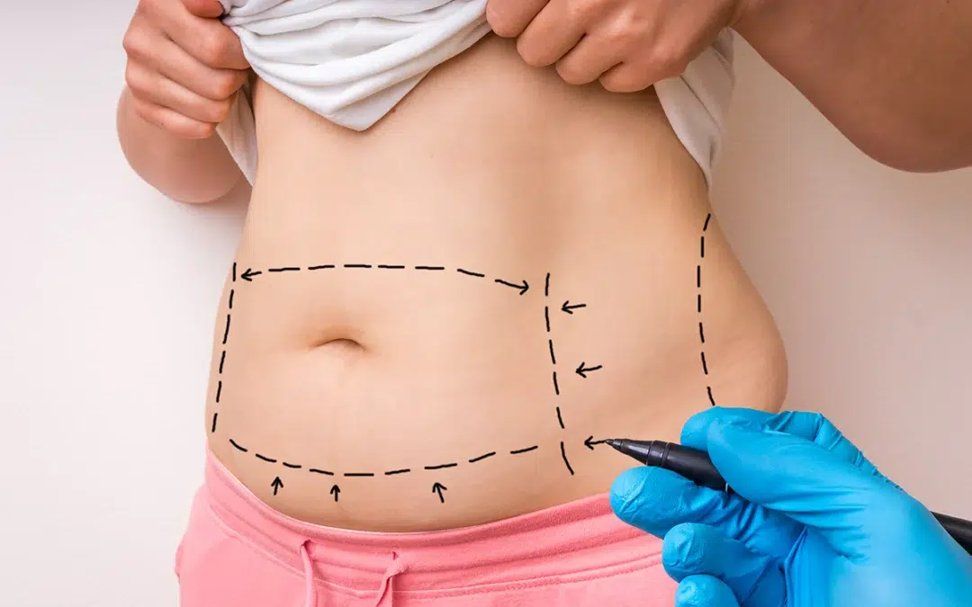 Tummy Tuck (Abdominoplasty) in Chicago for a Flatter, Toned Abdomen