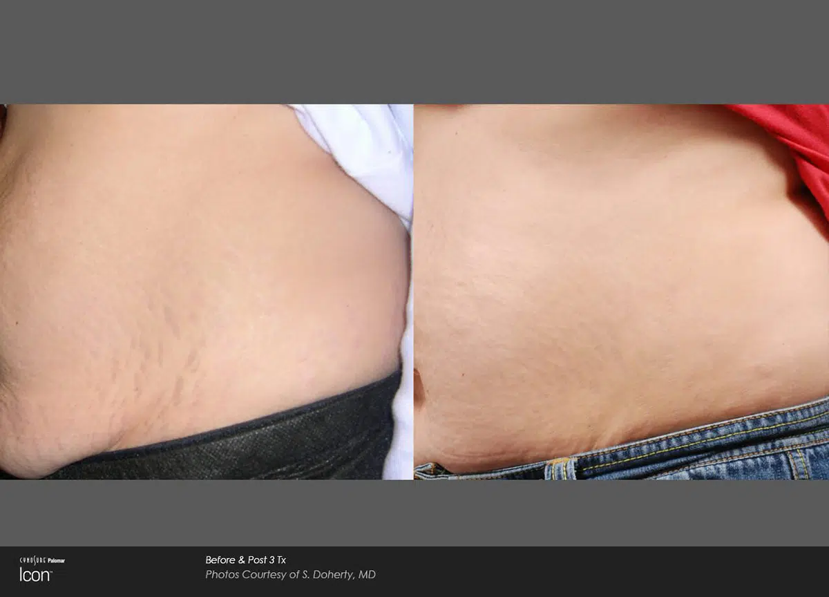 stretch mark before after