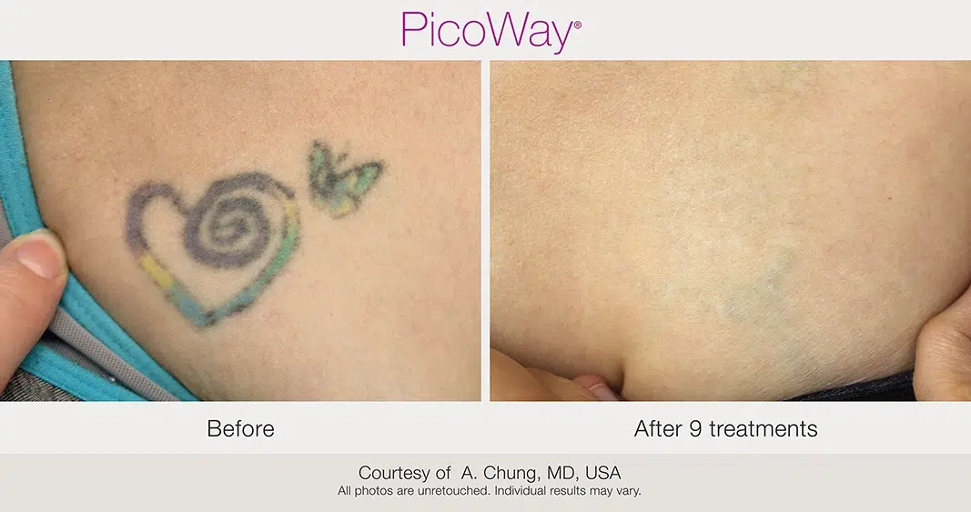 BA PicoWay AChung ChestTattoo tx min copia