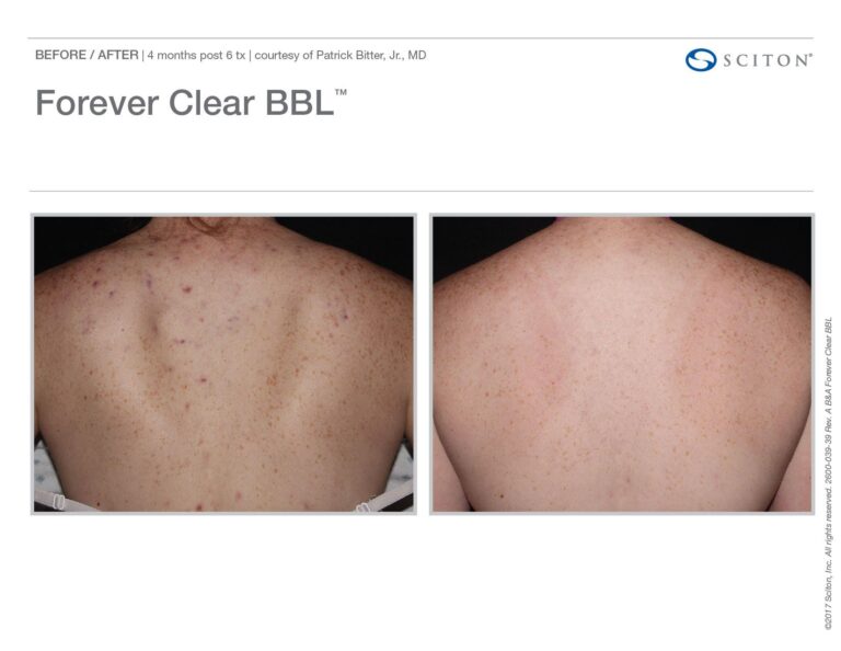 BBL Forever Clear Before and After Chicago Aesthetics x
