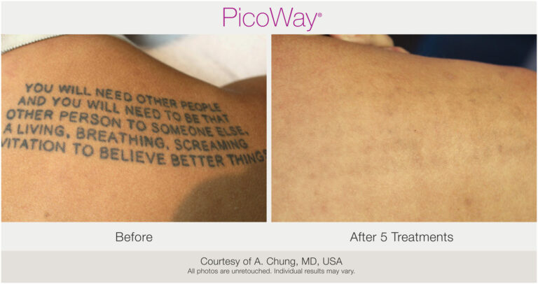 Before After PicoWay Tattoo Removal Tx x