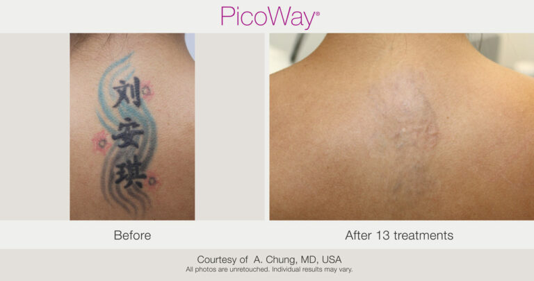 Before After PicoWay Tattoo Removal Achung Tx x