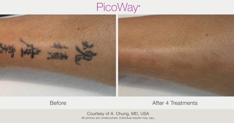Before After Picoway Laser Tattoo Removal tx x