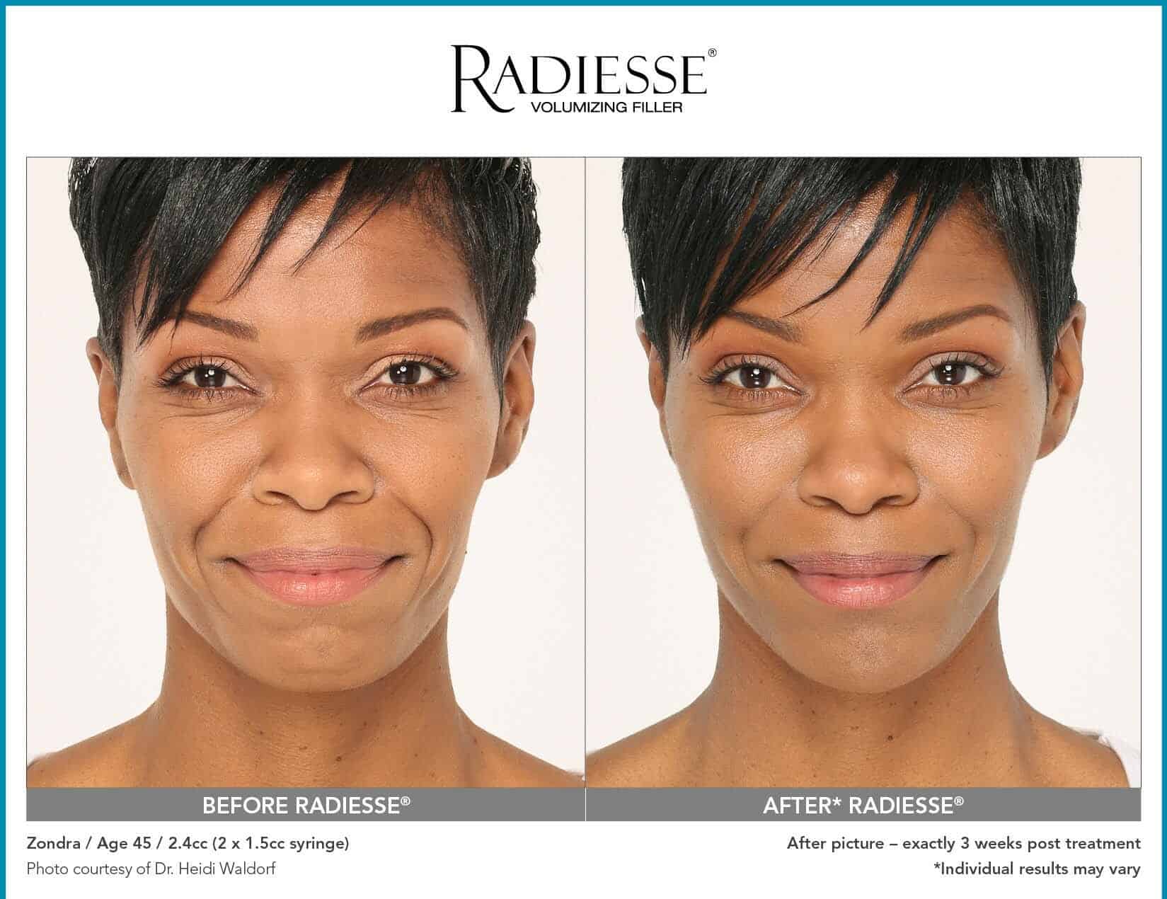 How much does radiesse cost