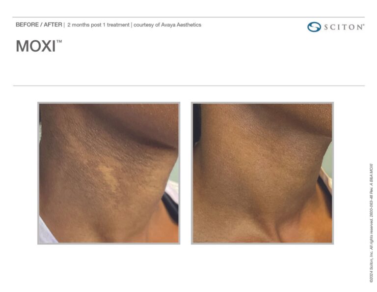 MOXI Before and After Chicago Aesthetics