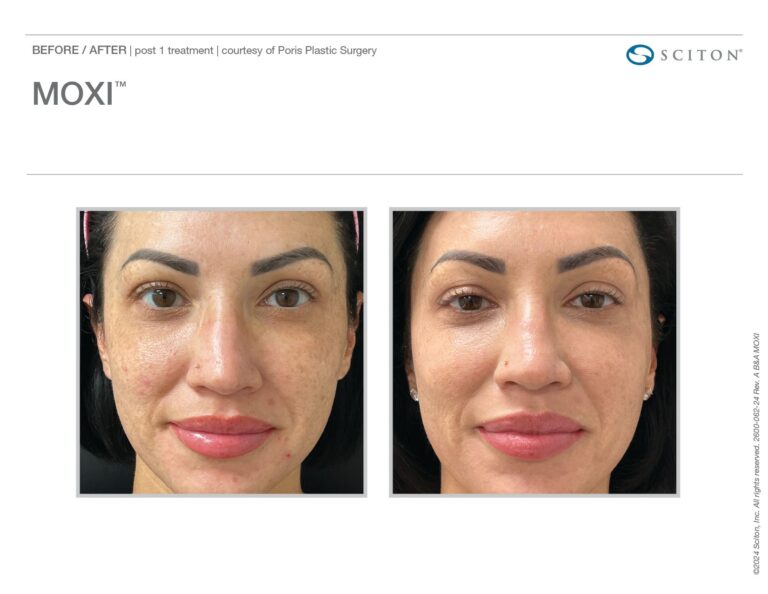MOXI Before and After image
