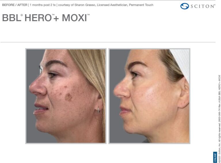 MOXI bbl Before and After