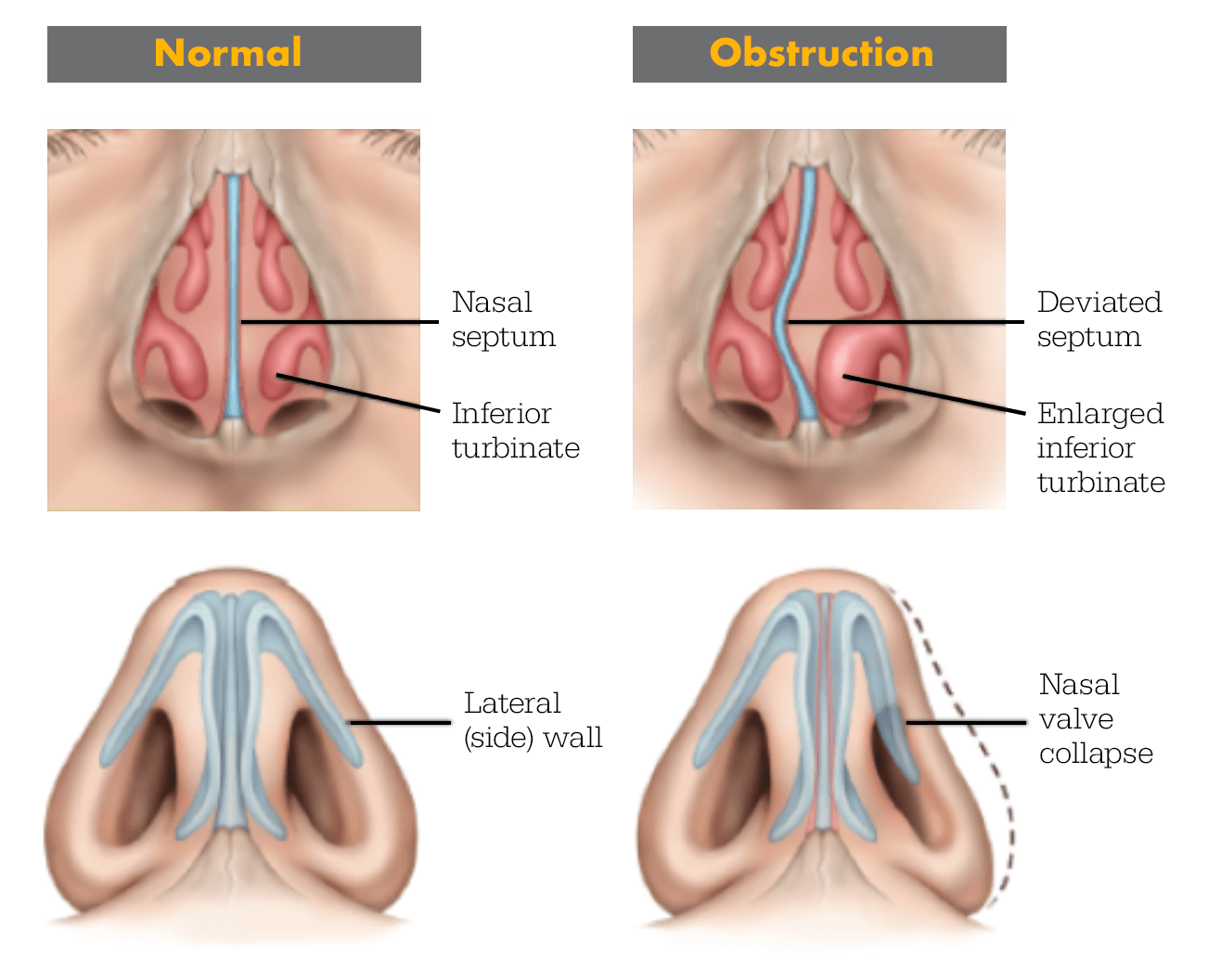 Illustration of Nasal Obstruction