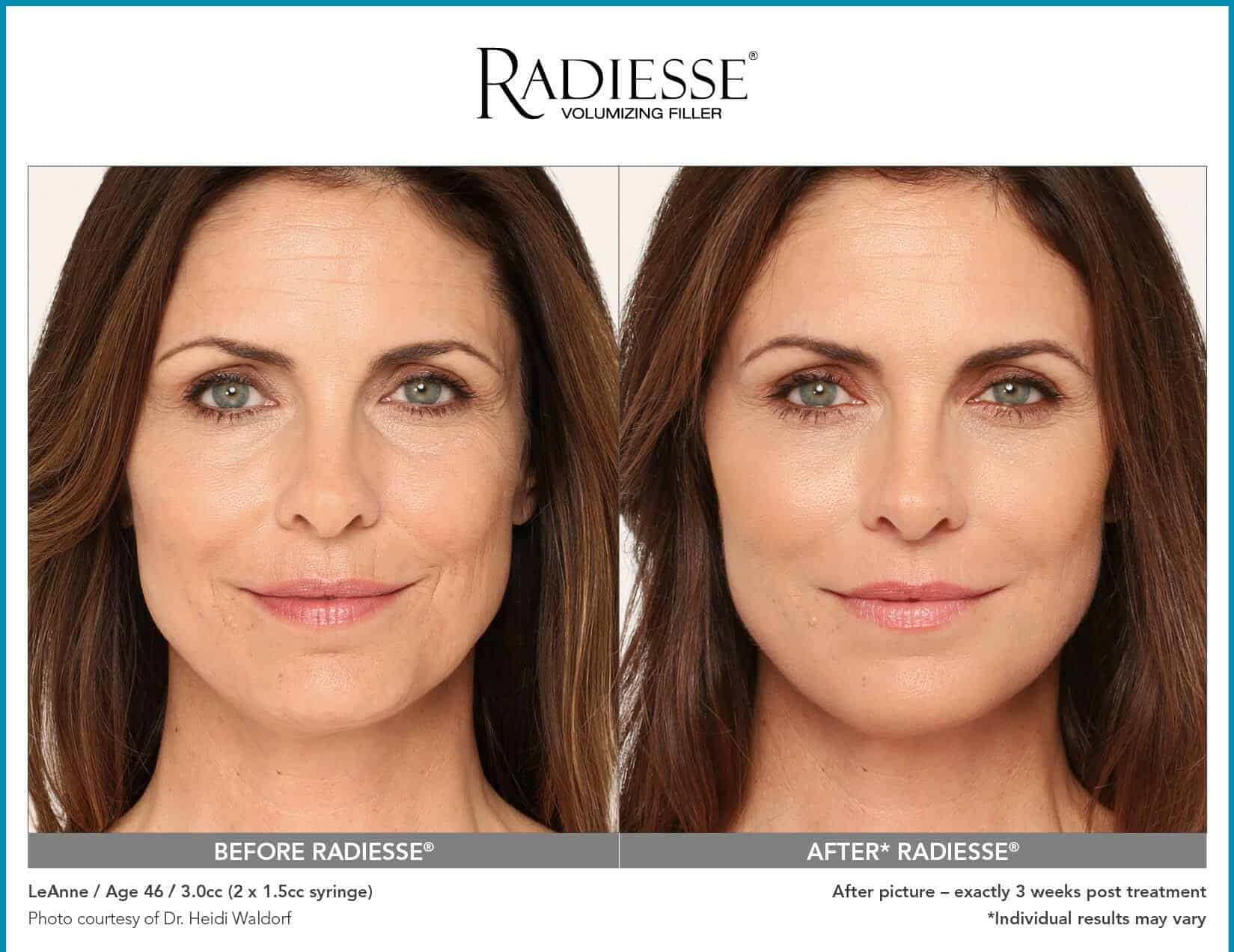 Radiesse before after photo chicago