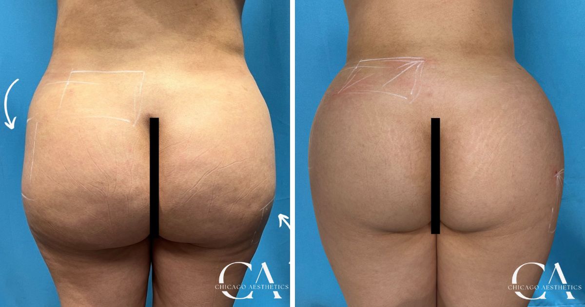 Sculptra BBL Before After Chicago Aesthetics