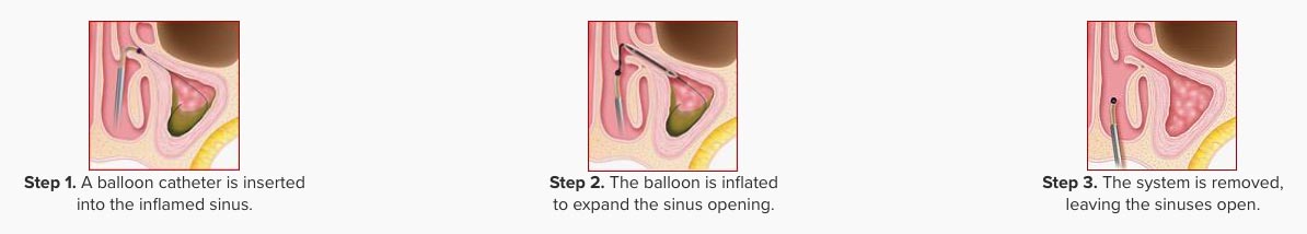the Balloon Sinus Dilation Procedure chart image of the 3 steps